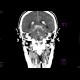 Subarachnoid hemorrhage: CT - Computed tomography